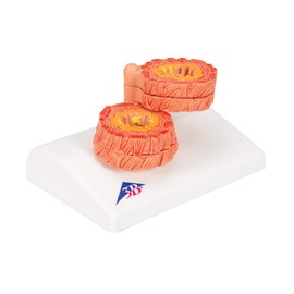 3B Scientific Human Anatomy - COPD Model + Free Anatomy App - 3B Smart Anatomy