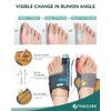 1 Pair Bunion Corrector Big Toe Straightener With 2 Angle