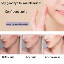 pimple patches Pimple Patches, Miracle Invisible Spot Cover - Hydrocolloid Acne Patch, Treatment for Breakouts, Absorbs Zits & Blemish-103pc