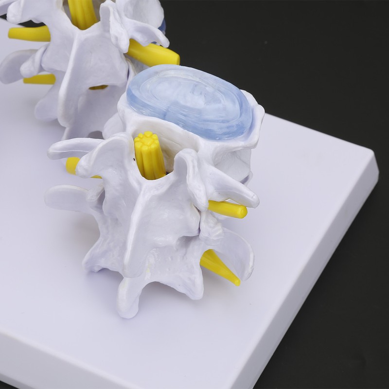 4-stage Medicals Human Lumbar Vertebrae Combination of Normal and Pathological