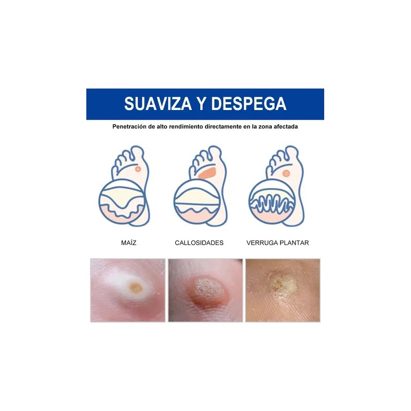 Sistema Verruga Elimina Plantar Comunes 30ml Neutra