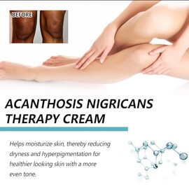 Bluemega Crema Acantosis Nigricans Loción Corporal Hidratante