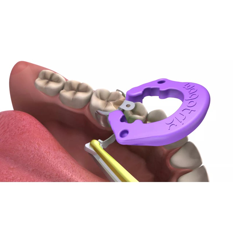 Wagotrix Universal Single-Use Matrix Rings - 100 Pack