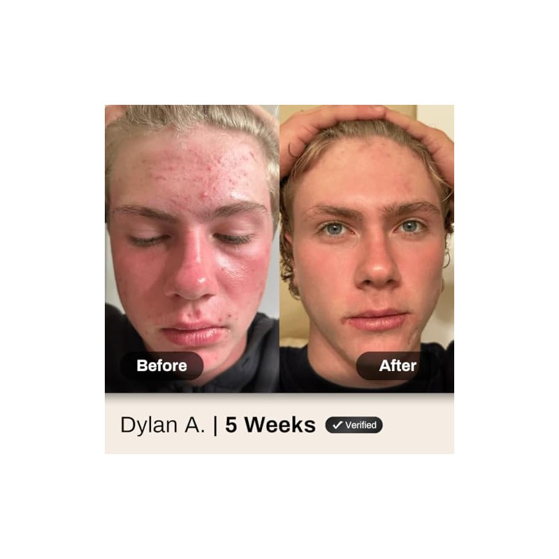 Shield System, Acne System for Men, Face Wash, Moisturizer, Pimple