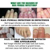 JAYSUING Ginger Nail Care Liquid, Nail Nutrients, Repairs Damaged and