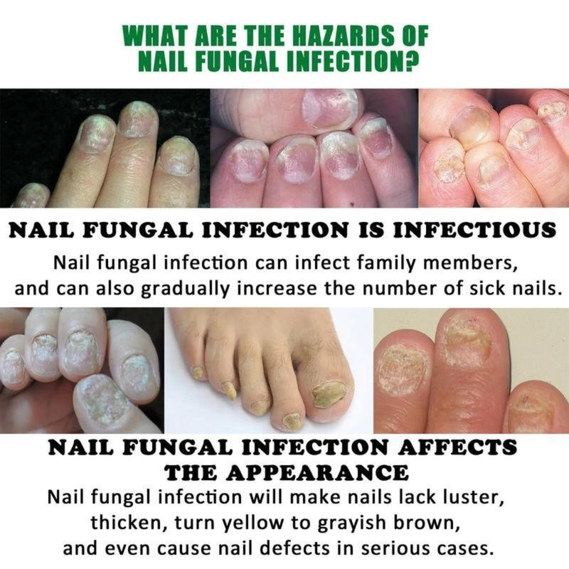 JAYSUING Ginger Nail Care Liquid, Nail Nutrients, Repairs Damaged and