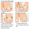 6 in 1 set Ingrown Toe Nail Fixer Pedicure Toenail