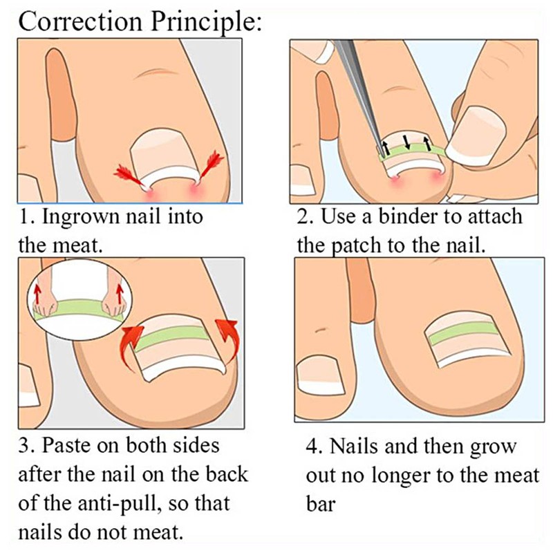 6 in 1 set Ingrown Toe Nail Fixer Pedicure Toenail