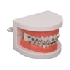 Dental Typodont Teeth Model with Orthodontic Metal Bracket for Dentist