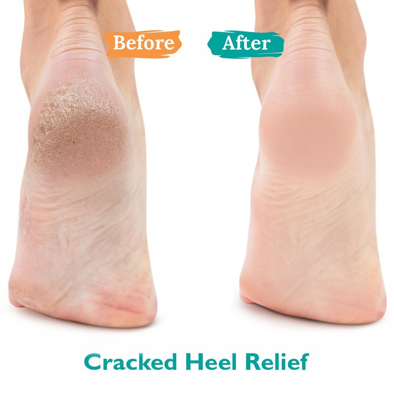 GILDEN TREE Urea Gel 42 Percent For Feet Maximum Strength