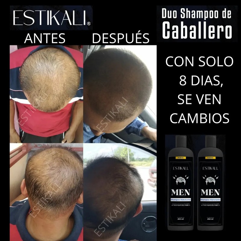 Shampoo Anticaída Anticaspa Antigraso Crecimiento De Cabello