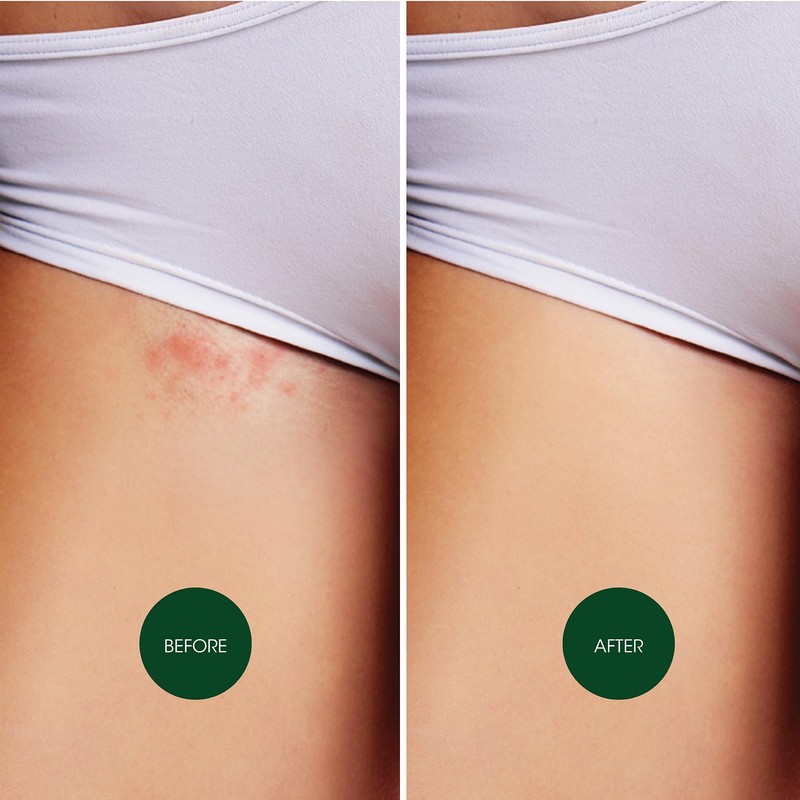 Nad's Nad's Soothing Ingrow Solution, Ingrown Hair Reduction, Treatment for