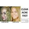 Sulfur Soap - Medical Grade OTC Dermatologists Approved 40 yrs
