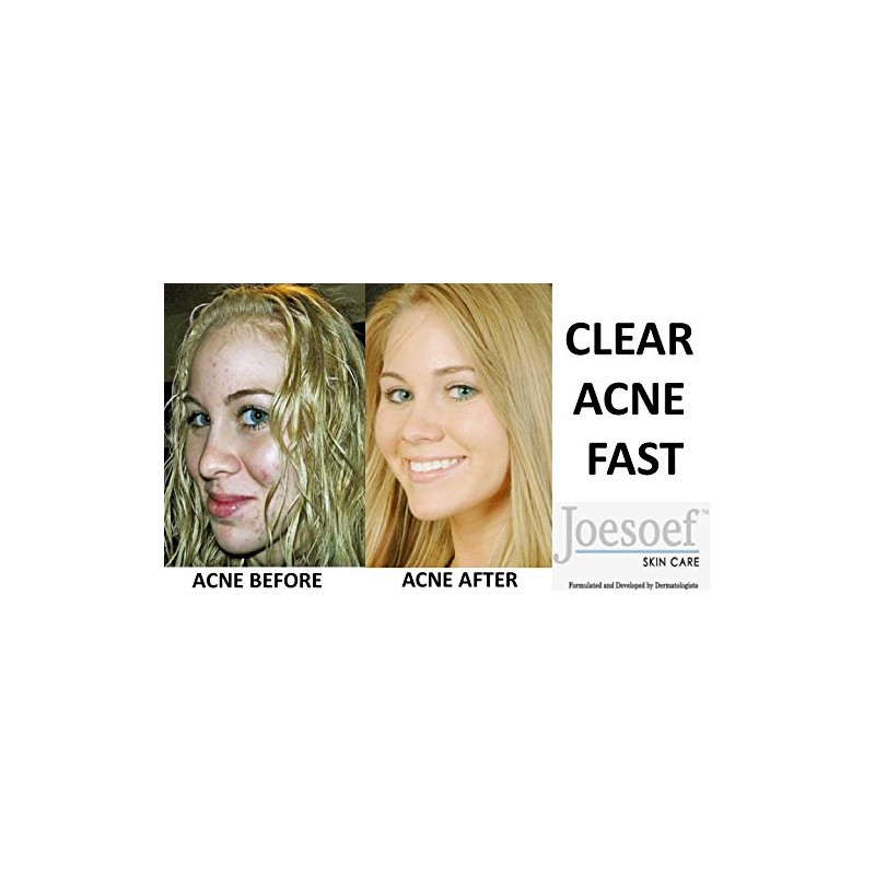 Sulfur Soap - Medical Grade OTC Dermatologists Approved 40 yrs