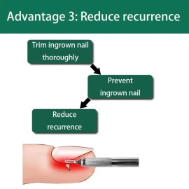 NONE Ingrown Toenail Pedicure Tool Kit, Nail Manicure Kit Stainless Steel, Ingrown.