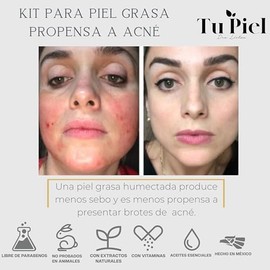 Kit para Piel Grasa y Acn Gel Hidratante Facial Piel Grasa, Suero de cido Saliclico 2, Suero de Niacinamida 10, Gel Limpiador Exfoliante Facial y...  