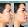 MARGARITA ABURTO Hieloterapia Facial Margarita Aburto