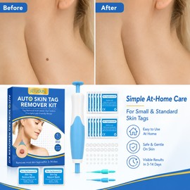 Skin Tag Removal Kit for Adults – 2-in-1 Banding Tool for At-Home Beauty & Grooming Care