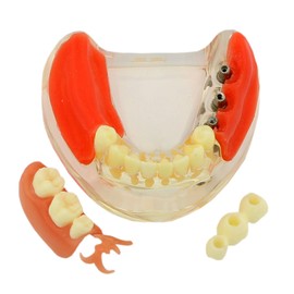 Dental Model Teeth for Teaching Studying Implant Restoration Removable Inferior Bridge Demo Model