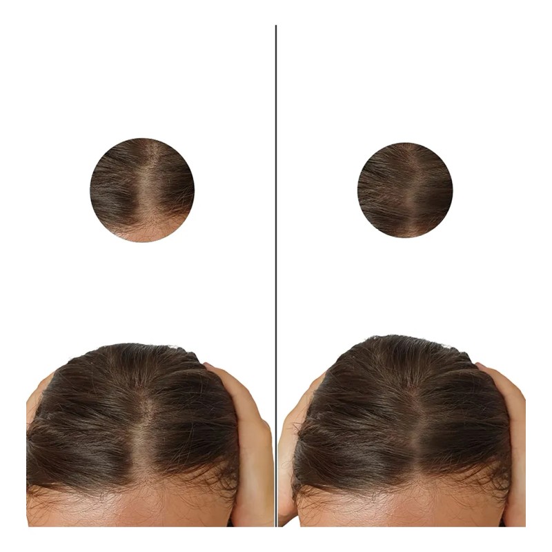 Minoxidil 5mg 50 Tabletas Minoxytop