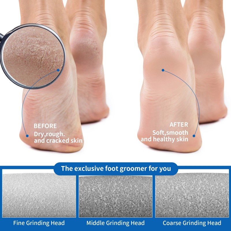 SEJOY Electric Callus Remover Foot Sander Rough Feet Rechargeable Dead