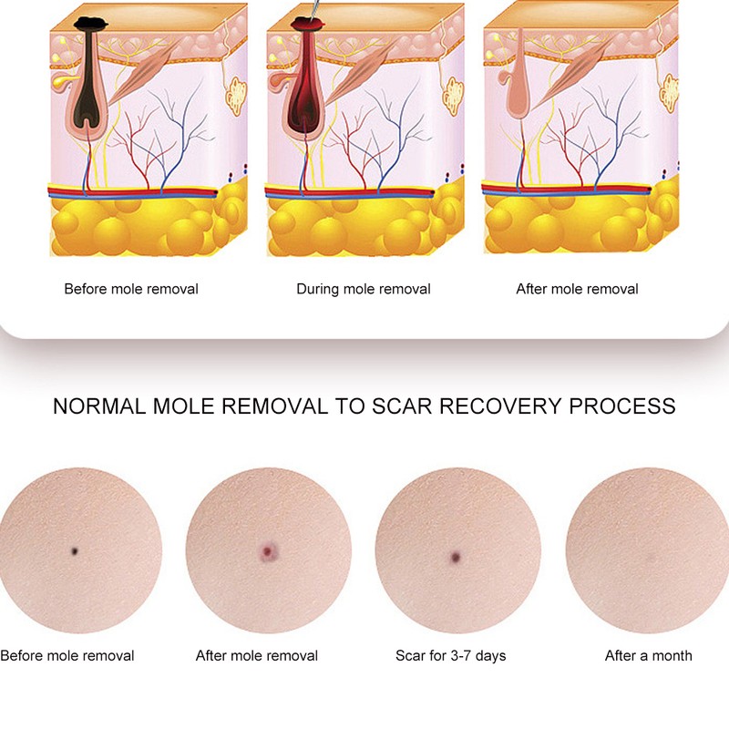 Mole Removal Pen USB 3 Gears Adjustment Freckle Spots Removal