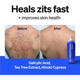 FRONTMAN Zit Spray for Men - Back Acne Treatment Spray for Clear Skin