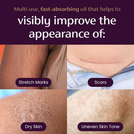 Mederma Quick Dry Oil - Scar and Stretch Mark Treatment, Improves Appearance with Natural Botanical Extracts, Paraben-Free, Fast-Absorbing, Hydrates Dry Skin, Reduces Uneven Skin Tone, 2.02 Oz (60ml)