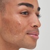 The INKEY List 2% Tranexamic Acid Serum to Reduce Hyperpigmentation