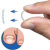 Young21 Ingrown Toenail Straightening Clip Curved Bs Brace Toenails Thick