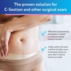 ScarAway Advanced Silicone Scar Sheets for C-Section, Reusable Strips (1.5”