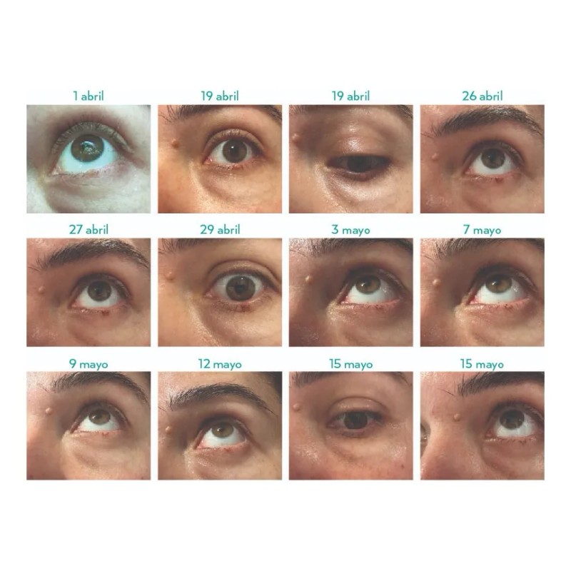 VerruClean® – Eliminación Natural de Verrugas