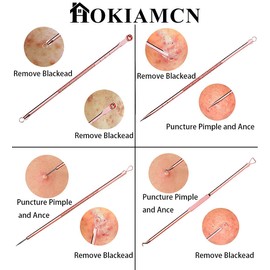 Blackhead Remover Kit, Extractor Removal Set Professional Stainless Steel Pimple Popper Tool Treatment for Whitehead Blemish Acne Comedone Pimple Popping (Gold)