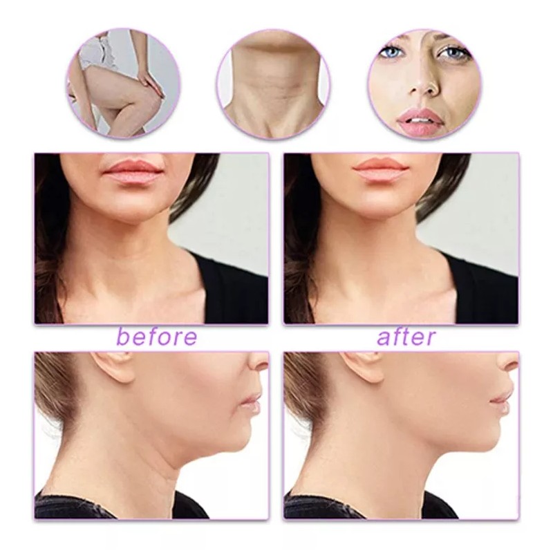 Wonder Point Dispositivo De Lifting De Arrugas Para La Piel