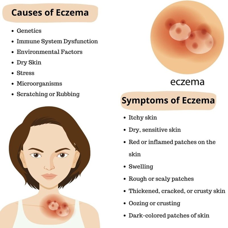 MercyBocu Eczema Cream Relief - All Natural No Chemicals -
