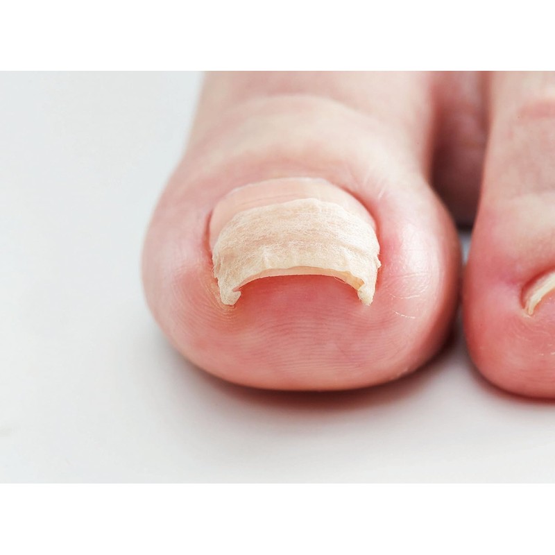 コジット 巻爪ケア シール ナチュラル 80枚 PROサポート