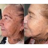 Crema Despigmentante Quita Manchas Acné Paño Vitíligo De 30g