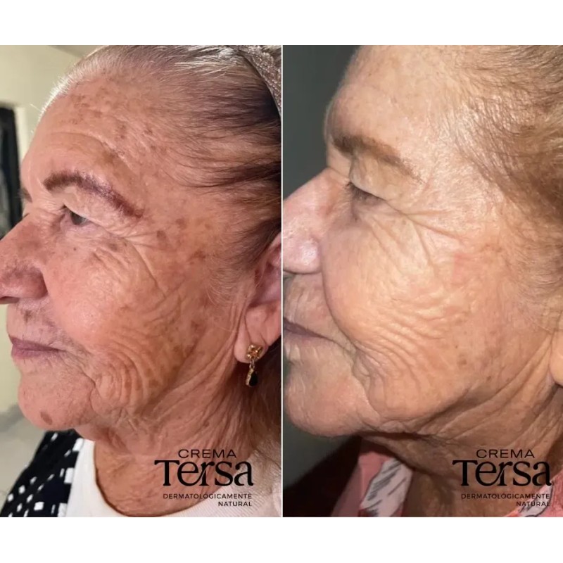 Crema Despigmentante Quita Manchas Acné Paño Vitíligo De 30g