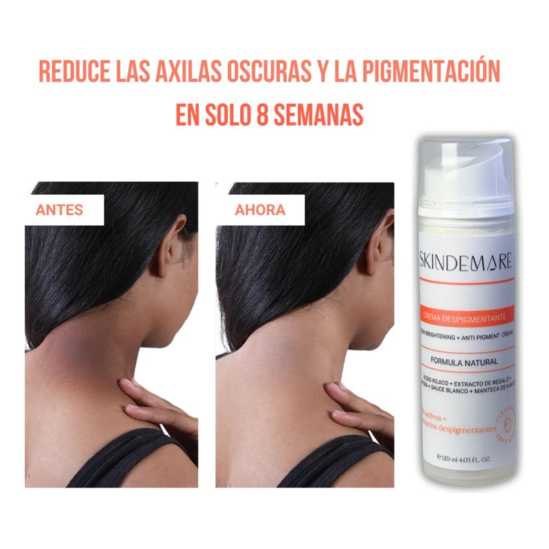 Crema Despigmentante Para Manchas, Melasma, Acné Y Paño Skid