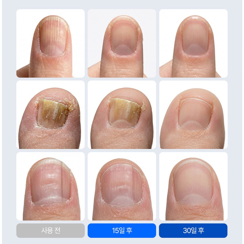Tracen Kerasoft Nail and Toenail Nutrient Ampoule, 30ml, 2 Pieces