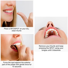 MYOSPOTS Tongue Exercise Spots – Myofunctional Therapy Tool for Correct Tongue Posture & Nasal Breathing | 100 Dissolvable Spots in Blueberry Flavour | Improve Oral Muscle Strength, Swallowing & Sleep Quality