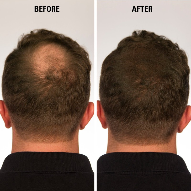 Infinity Hair Fiber – Corrector de pérdida de cabello –