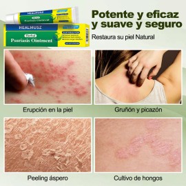 Crema De Psoriasis Para Varios Síntomas De Psoriasis 20g