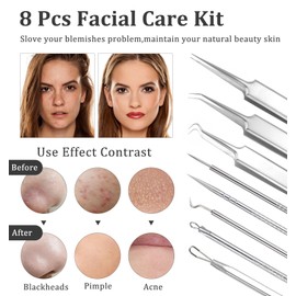 8 Stück Pickel Pinzette, Pickel Ausdrücken Werkzeug Hochwertiger Edelstahl Akne Mitesser Entferner, Gesichtspflege Set mit Box, Ideal für Hautpflege
