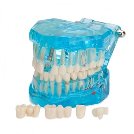 UKYCEORA Transparent Disease Teeth Model, Dental Implant Bridge Dental Teaching Crown Bridge Removable Model Teeth for Patient and Dental Student Education Transparent Blue