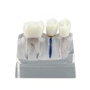Ultrassist Modelo de implante dental, transparente