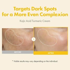 Zz Crema De Hiperpigmentación: 99% De Ácido Kójico Y