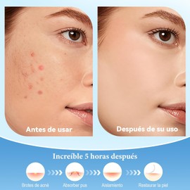 200PCS Parches para Acne, Pimple Patch, Calcomanías Ultra Finas para Cara y Piel, Parches Hidrocoloides Transparentes para Granos y Espinillas, Reducen el enrojecimiento y absorben las Secreciones