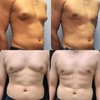ThermoFirm Bee Venom Gynecomastia Oil, 2026 New Chest Muscles Bee
