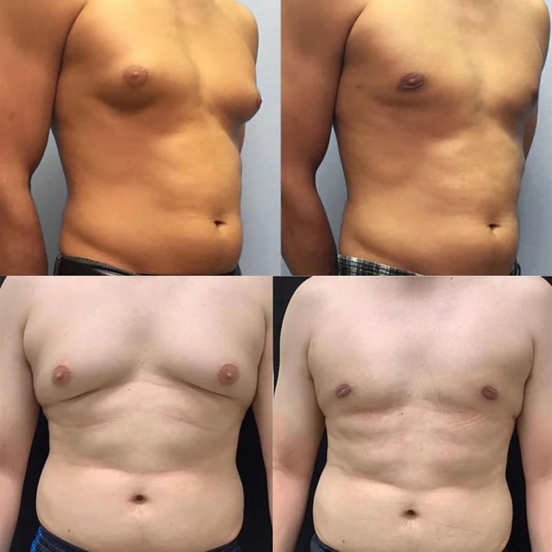ThermoFirm Bee Venom Gynecomastia Oil, 2026 New Chest Muscles Bee